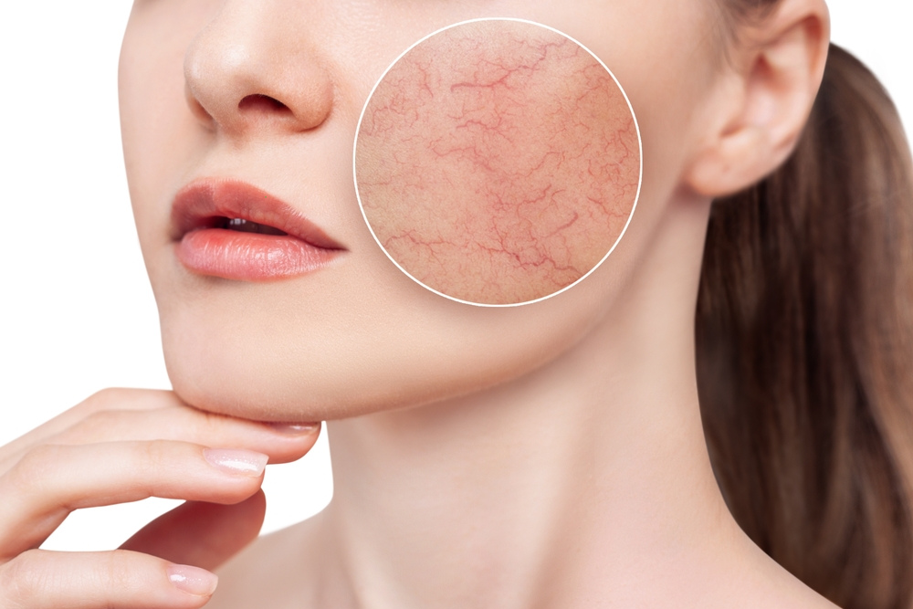 Skuteczna pielęgnacja cery naczynkowej – praktyczny poradnik